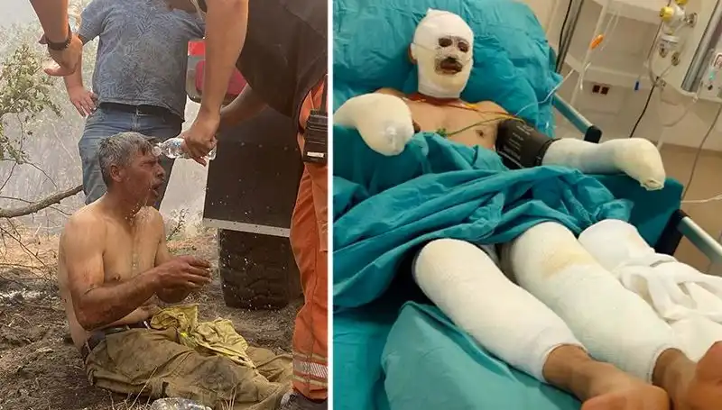 Orman İşçisinin 'Yanıyorum' Feryadı: Psikolojik Etkileri ve Tedavi Süreci