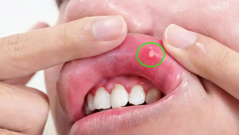B Vitamini Eksikliği: 5 Belirgin Belirtiyi Gözden Kaçırmayın!